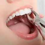 EXTRACCIÓN DENTAL